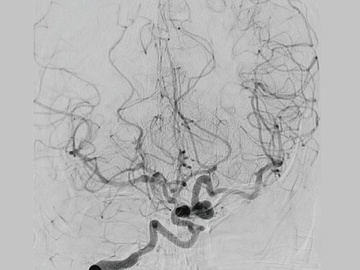 Giant serpentine aneurysm with difficult anatomy