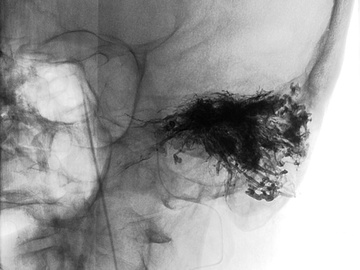 Glomus transarterial embolization with EVOH