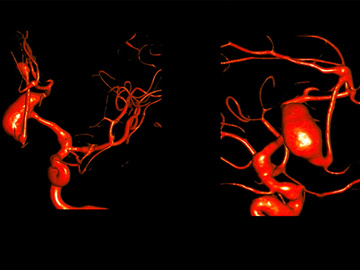 Growing fusiform posterior cerebral artery aneurysm treated with Flow Diverter