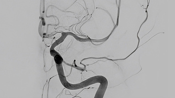 ICA-M1 intracranial dissection EVT