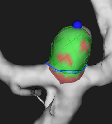 Implantation of an Artisse™ intrasaccular Device for an incidental Acom aneurysm