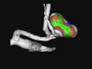 Incidental ACom Aneurysm with intrasaccular flow-diverting device in a challenging anatomy