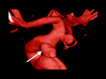 Incidental distal PICA Aneurysm