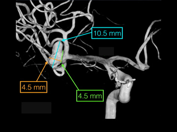 Growing fusiform posterior cerebral artery aneurysm treated with Flow Diverter