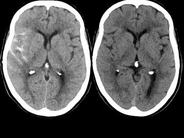 Indications of intra-cranial stenting for failed thrombectomy