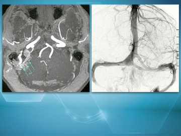 Innovative treatment for recurrent sigmoid sinus DAVF