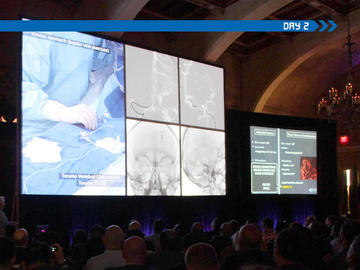INR approaches to stroke and aneurysms