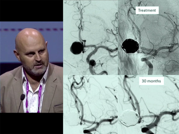 Over 40 years old and still inspiring innovation in cerebral aneurysm treatment