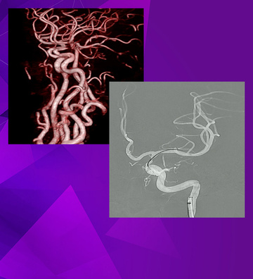 Intracranial atherosclerotic disease - Live Case