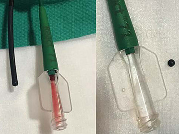 Intracranial Pellet Embolization; An Endovascular Endeavor