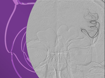 Double stenting technique thrombectomy and PTA treatment for intracranial stenosis