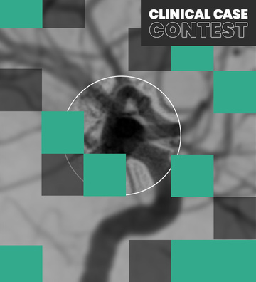 Intrasaccular aneurysm treatment: Top cases revealed!