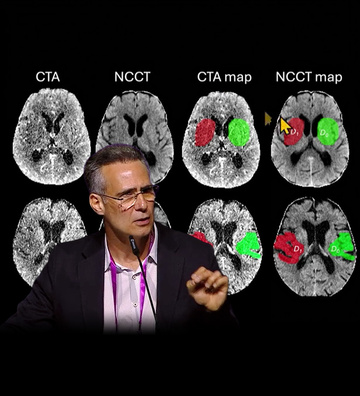 Is NCCT powered by AI the future of acute stroke triage?