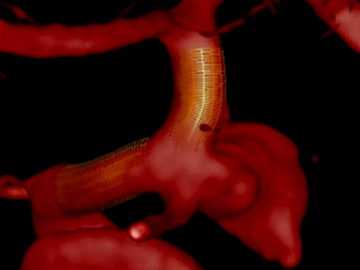Treatment of a large carotid artery aneurysms with flow diverter 