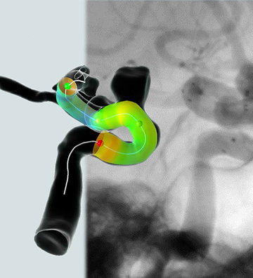 Large paraclinoid aneurysm treated with flow diversion with OCT control