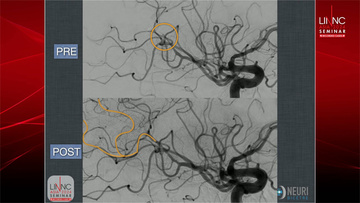 Left distal M2 mechanical thrombectomy with stent retriever