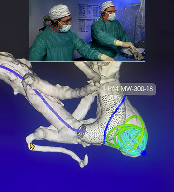 Left MCA fusiform aneurysm treated by FD and coils