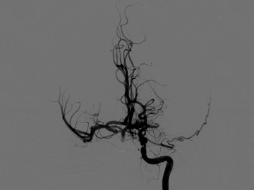 Left MCA M1 Occlusion treated with STAT technique 