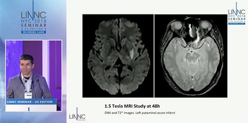 Left MCA Sub occlusion