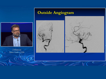 LINNC Paris 2022: A complex right MCA bifurcation aneurysm 