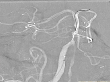 Live Cases: BA stenosis angioplasty using laser cut stent and Cavernous DAVF embolization