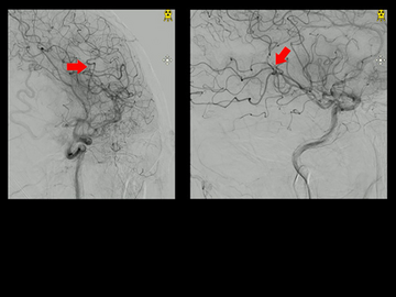 Low NIHSS thrombectomy: benefit risk balance of GA