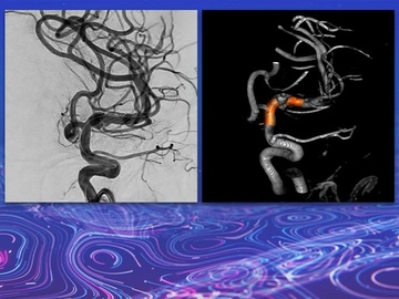 M1 Fenestration aneurysm with early origin of the MCA
