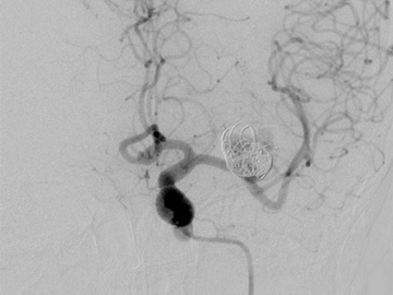 M1 left aneurysm