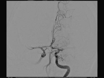 M1 occlusion with persistent MeVO