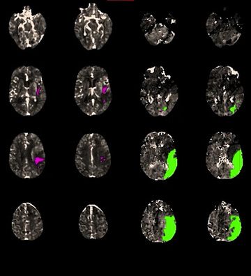 M2 thrombectomy in a 91-year-old: decision-making in a high‑risk patient