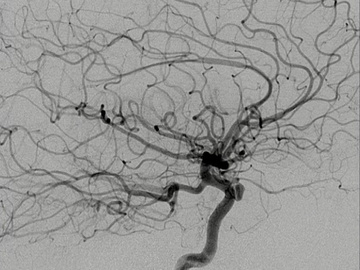 Management of ophthalmic artery pseudoaneurysm in one-eyed (other eye) patient