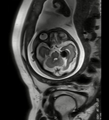 Master pediatric neurointervention: from diagnosis to treatment strategies