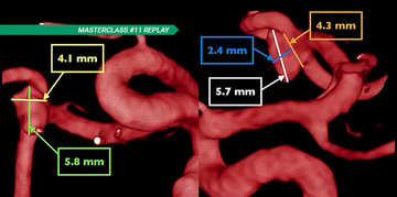 FD and WEB for bifurcation aneurysm: a complementary competition?