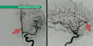 Flow diverters or stents-coils for distal aneurysms: enemy brothers?