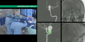 MASTERCLASS - Is the carotid siphon the private turf of the flow-diverter? 