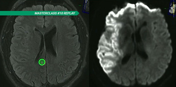 Masterclass - M1 thrombectomies: frequency does not mean zero problems. So what are the questions?