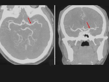Growing fusiform posterior cerebral artery aneurysm treated with Flow Diverter