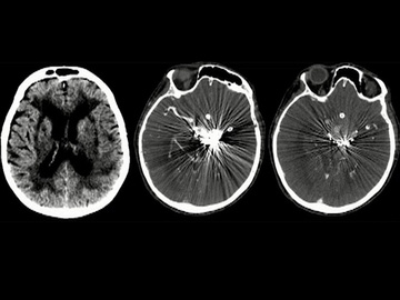 Mechanical thrombectomy in a patient with previously treated giant fusiform aneurysm