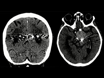 Mechanical thrombectomy in a patient with previously treated giant fusiform aneurysm
