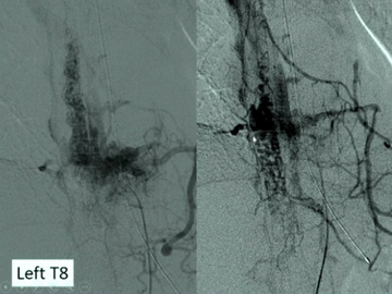 Metameric spinal arteriovenous malformation - Case presented by Italo Linfante