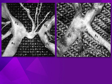 Micro-neuroangiography of the Anterior Communicating Artery Complex and Its Perforators