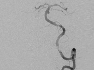 Mid basilar artery aneurysm: how would you treat?