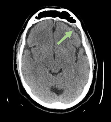 Middle meningeal artery embolization for recurrent chronic subdural hematoma