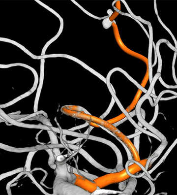 Mycotic M4 Sylvian aneurysm mistaken for ischemic stroke, treated using flow diversion