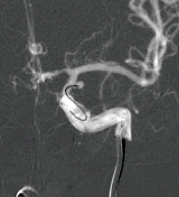 One&Done coiling for tiny aneurysms