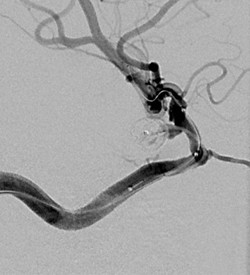 PCOM rupture embolization with contemporary tetrahedral coil