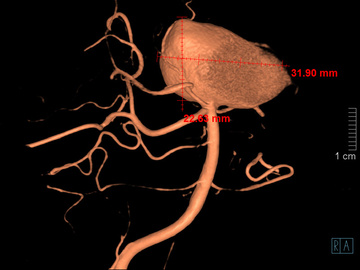 Pediatric giant basilar top aneursym, stent assisted coil embolization
