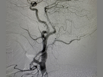 Persistent hypoglossal artery