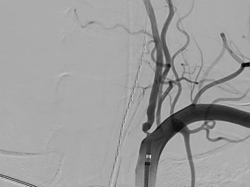 Transcranial embolization of a superficial DAVF