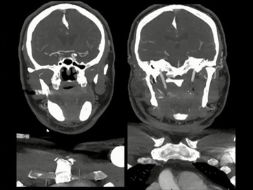Pseudo-occlusion and two exceptions to the rule